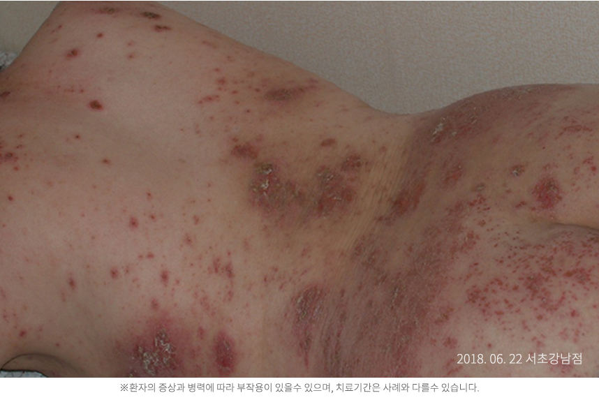 습진 병력 20년 60대 여자