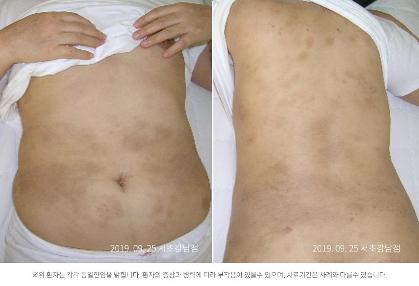 하늘마음한의원 청열 해독후 치료된 모습