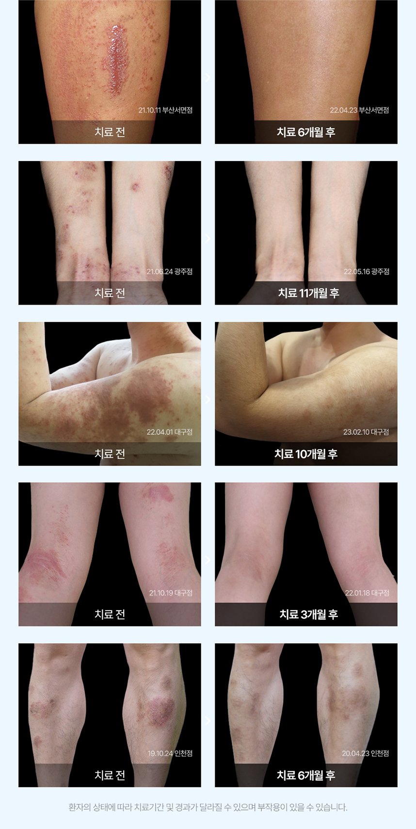 습진 치료 전후 사례