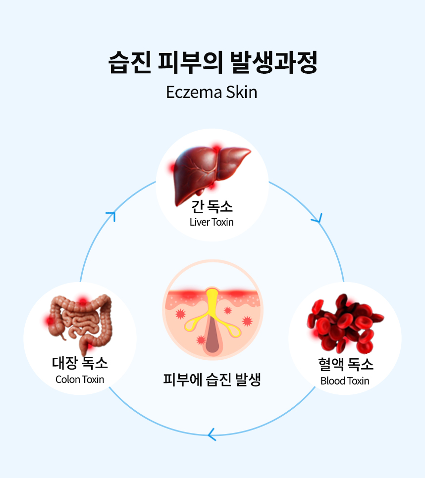 습진 피부의 발생과정