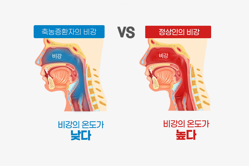 축농증(부비동염)환자 : 비강의 온도가 낮다, 정상인 : 비강의 온도가 높다