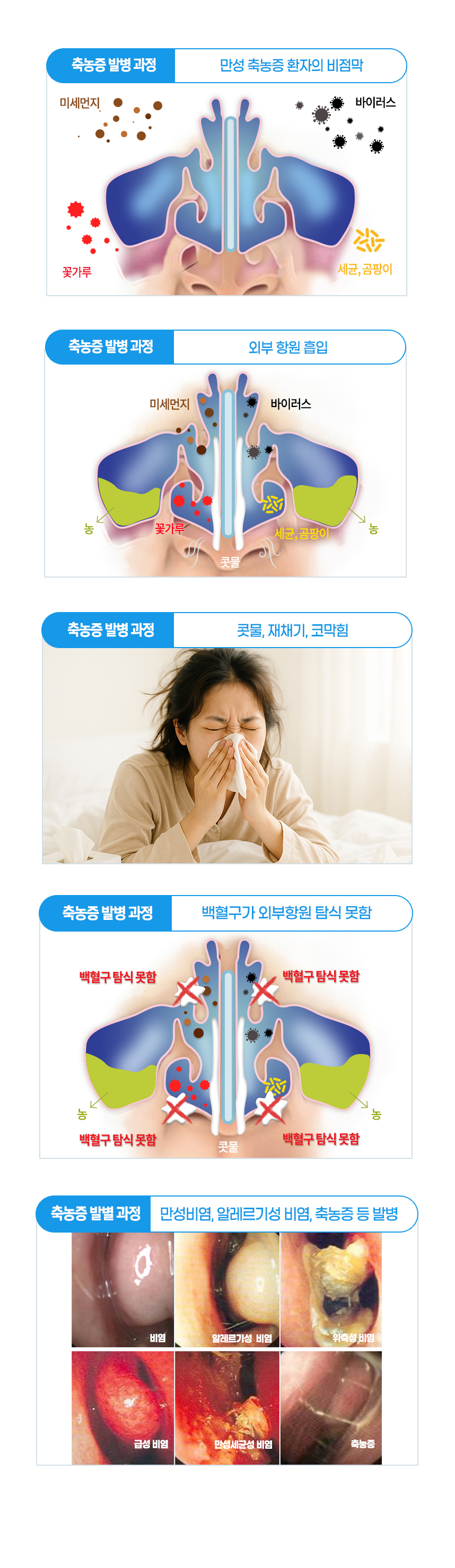 축농증(부비동염) 발병 과정 : 외부 항원 흡입 - 콧물, 재채기, 코막힘 - 백혈구가 외부항원 탐식 못함