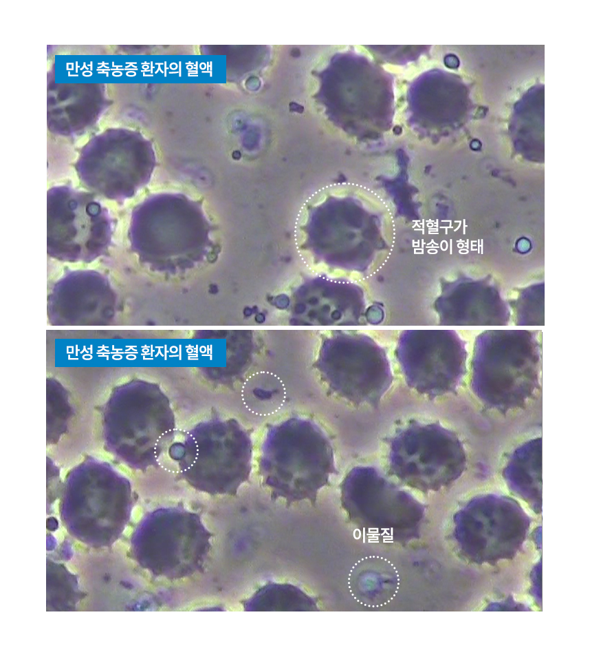 만성 비염 환자의 혈액 : 적혈구의 형태가 밤송이 같은 형태이고, 이물질들이 많이 떠다니는 것을 볼 수 있습니다.