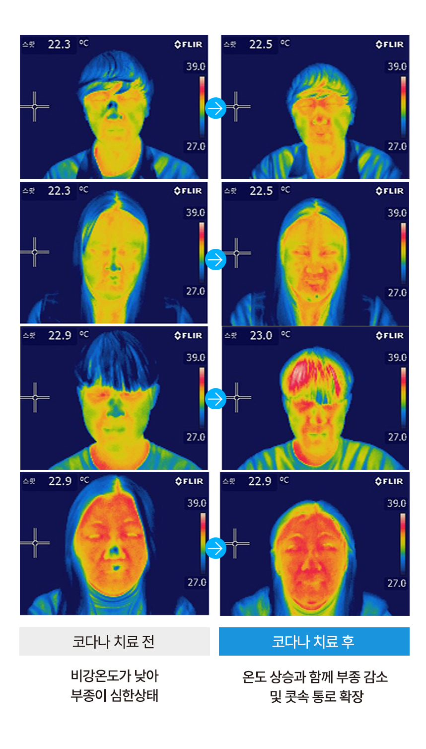 코다나 치료 전 : 비강온도가 낮아 부종이 심한상태, 코다나 치료 후 : 온도 상승과 함께 부종 감소 및 콧속 통로 확장