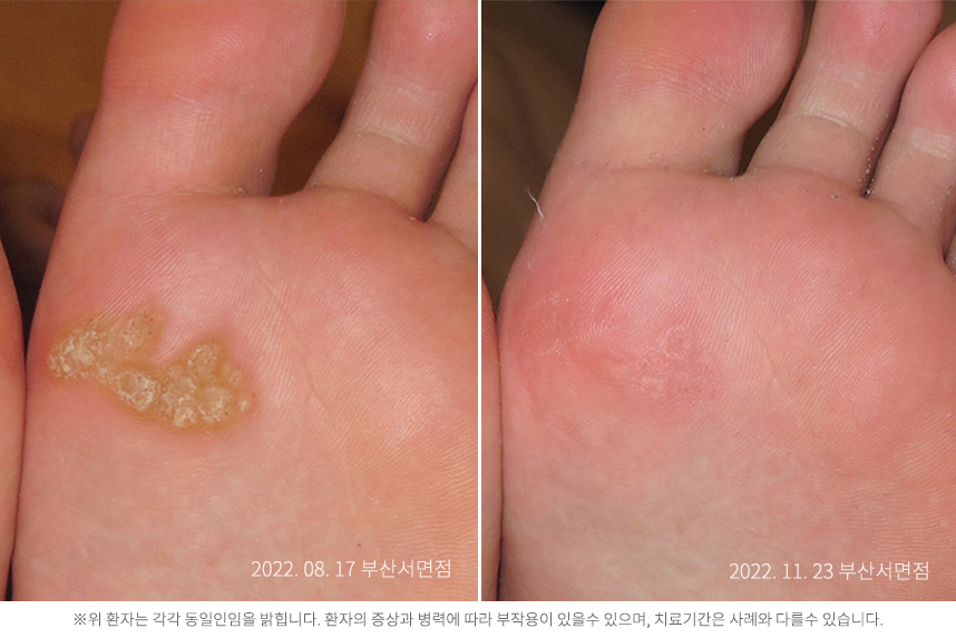 사마귀 병력 3년 20대 남자