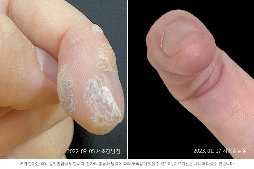 사마귀 병력 2년 30대 남자