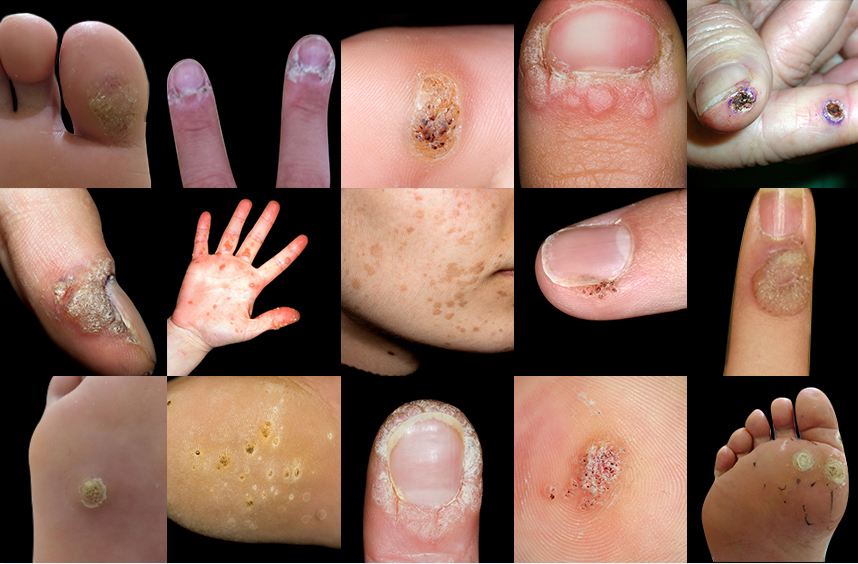 다양한 부위에 발병된 사마귀 사례들
