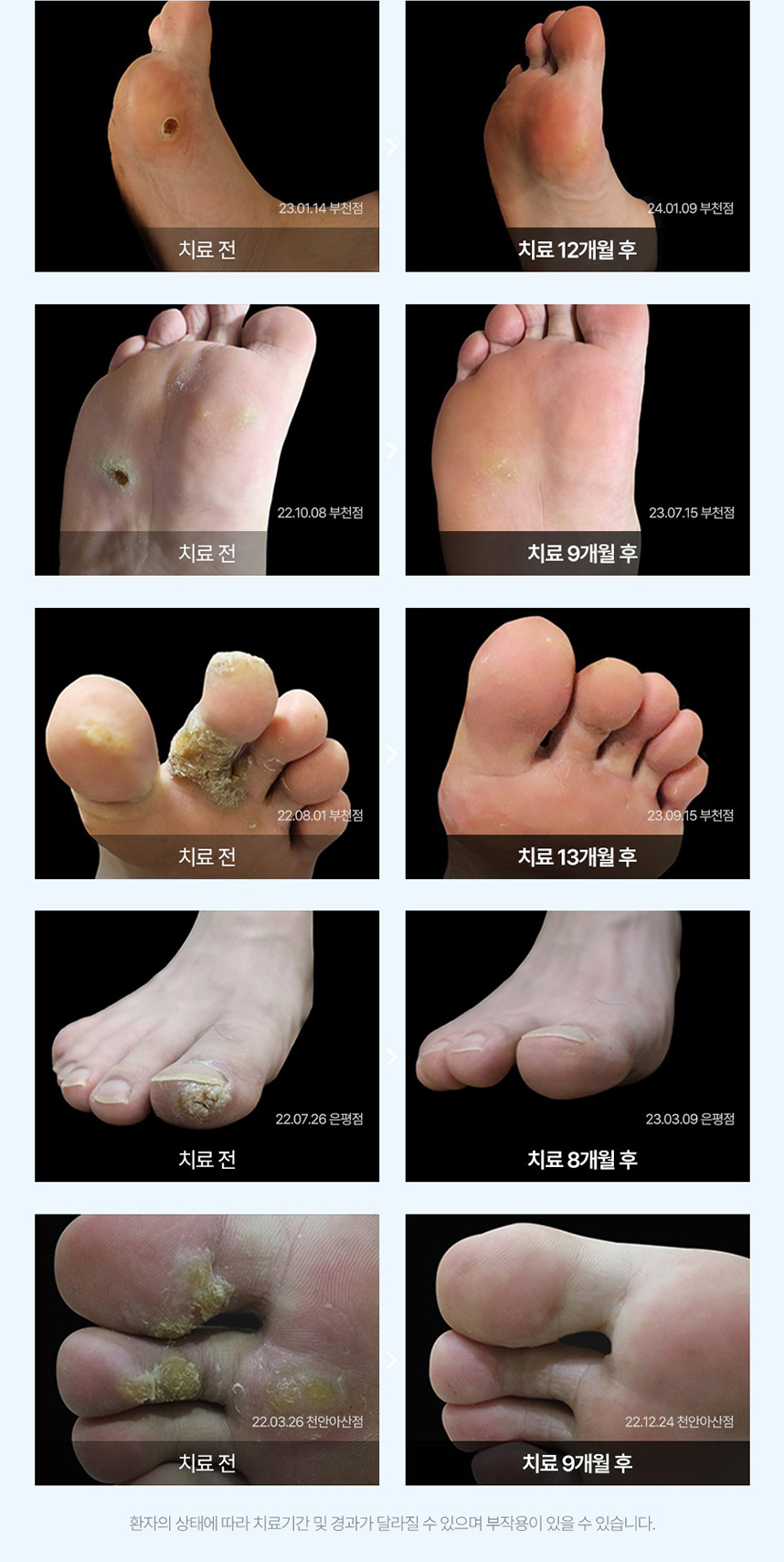 사마귀 치료 전후 사례