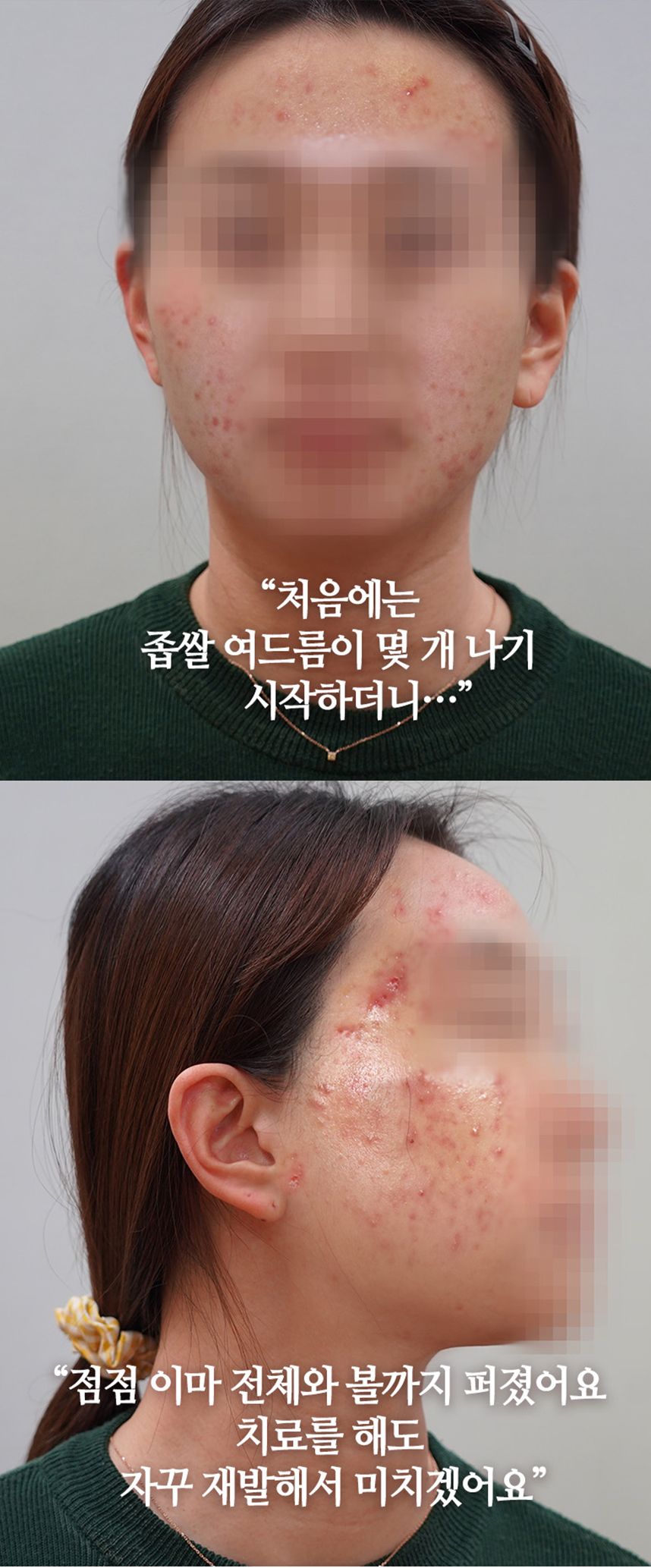 점점 이마 전체와 볼까지 퍼졌어요 치료를 해도 자꾸 재발해서 미치겠어요