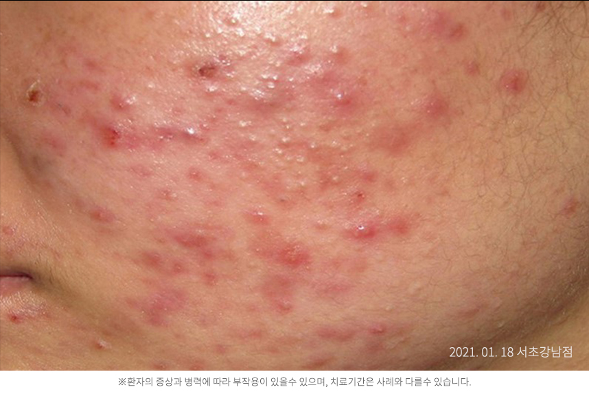 여드름 병력 3개월 10대 여자