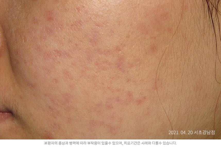 여드름 병력 3개월 10대 여자