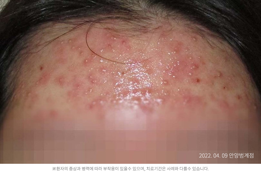 여드름 병력 2년 20대 여자