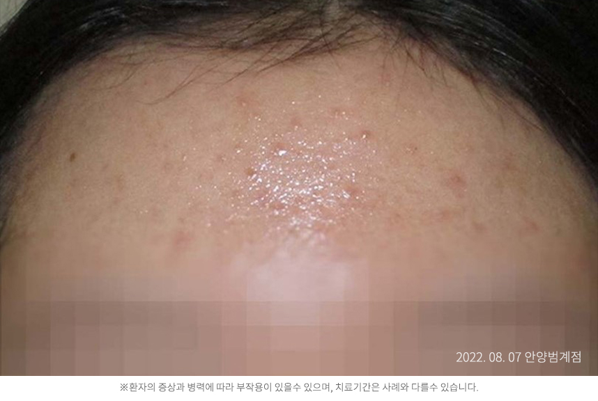 여드름 병력 2년 20대 여자
