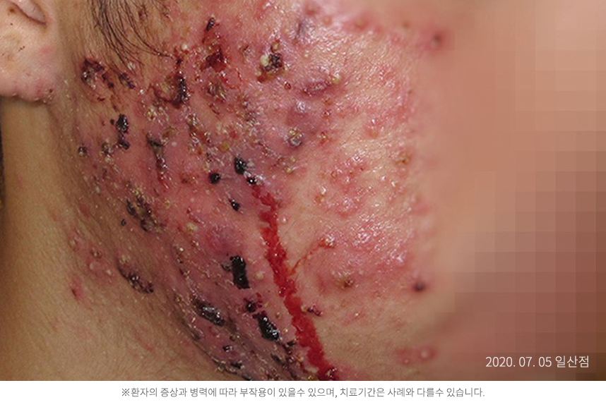 여드름 병력 6년 30대 남자 