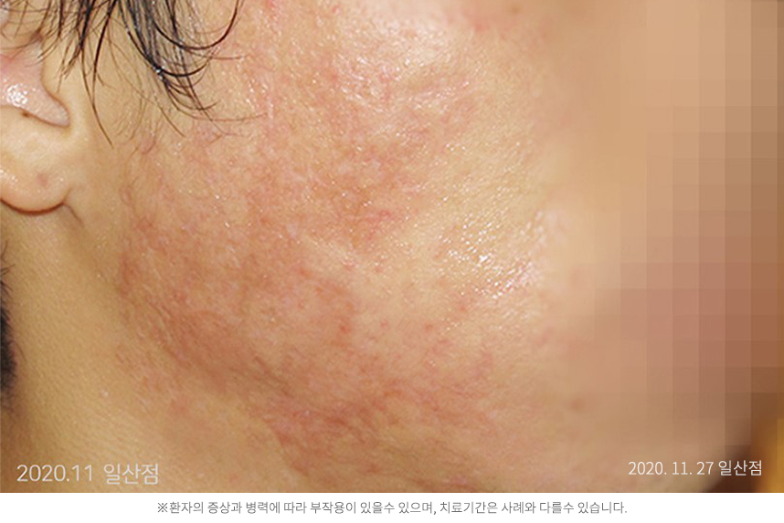 여드름 병력 6년 30대 남자 