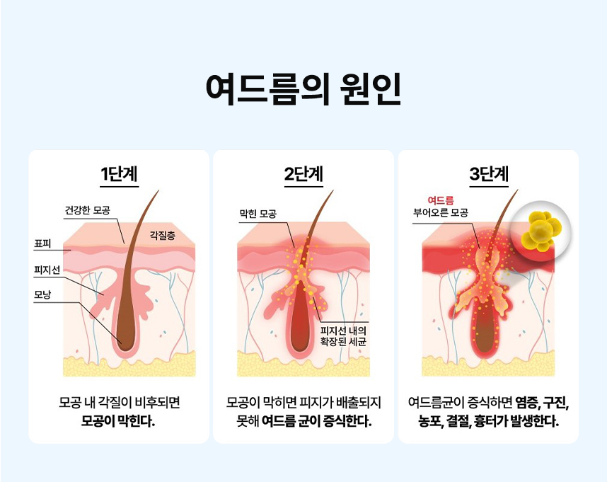 피부 속 독소