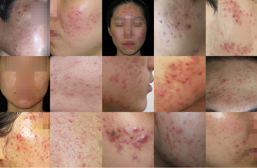 다양한 부위에 발병된 여드름 사례들