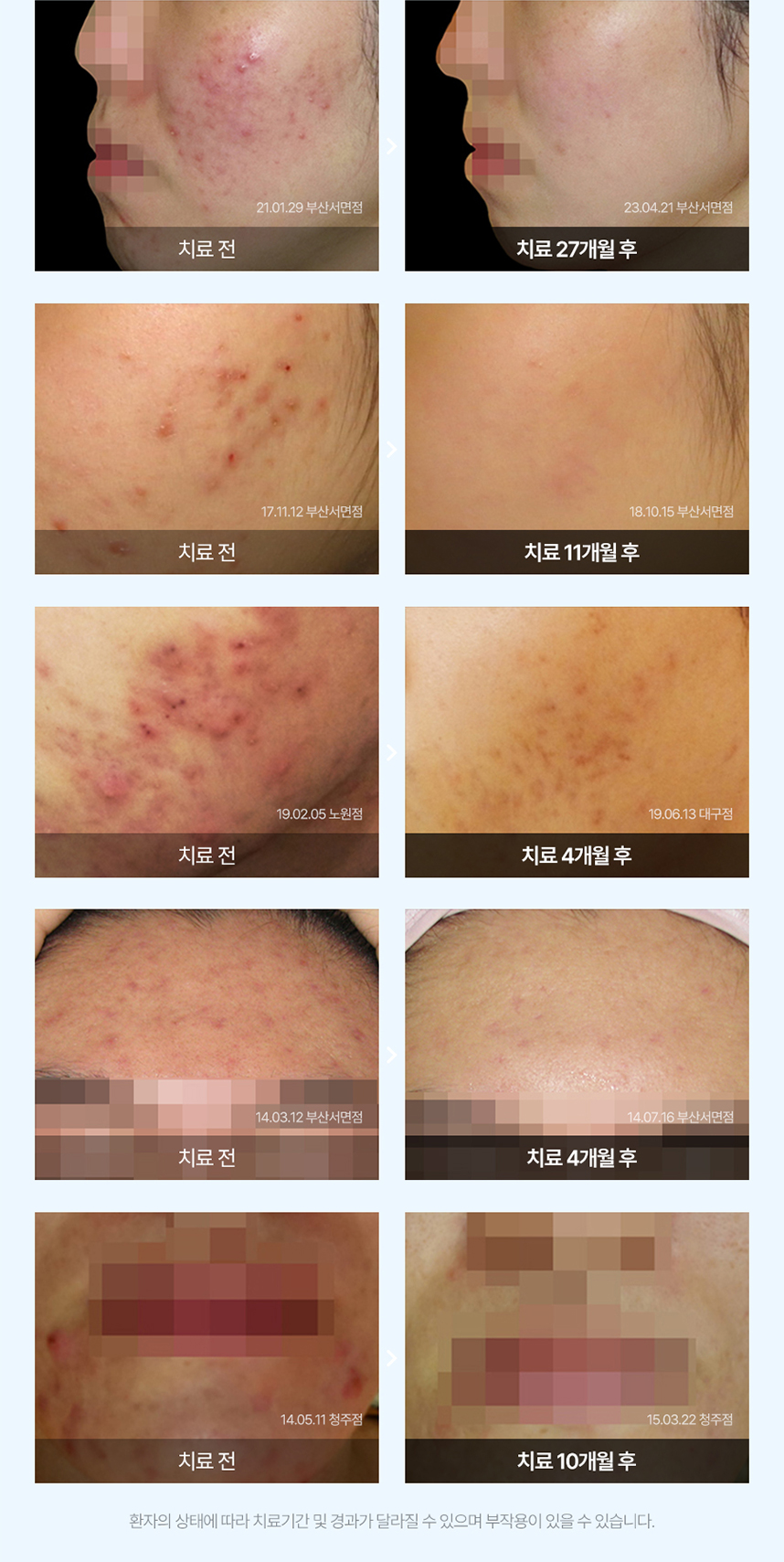 여드름 치료 전후 사례