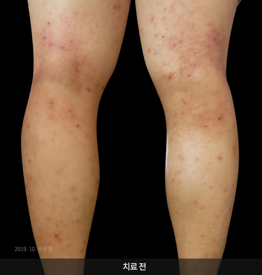 아토피 치료 전 사진