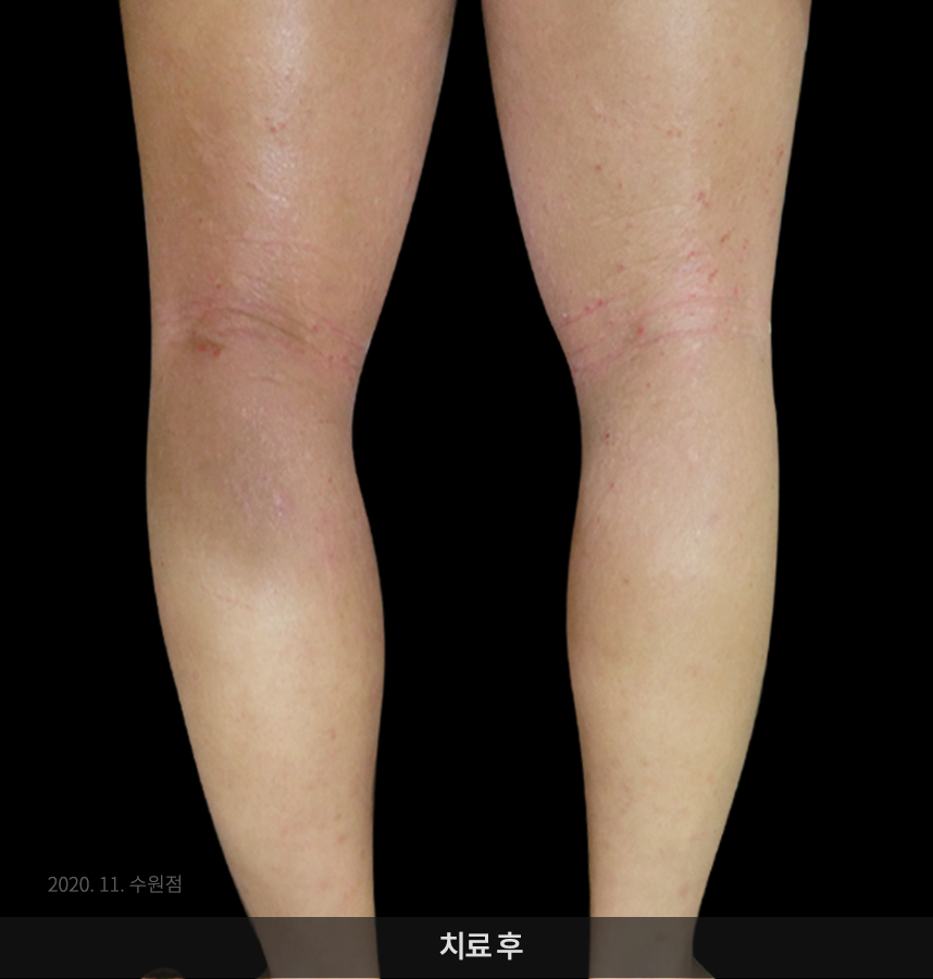 아토피 치료 전 사진