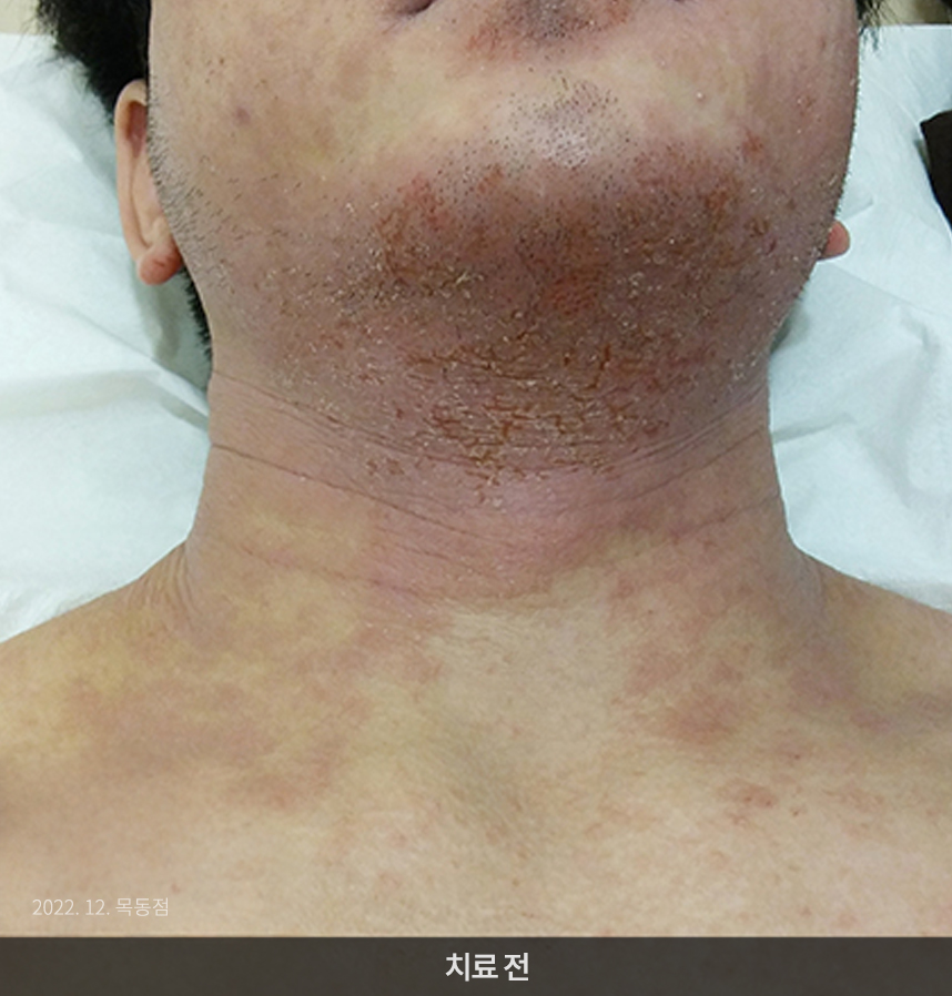 아토피 치료 전 사진