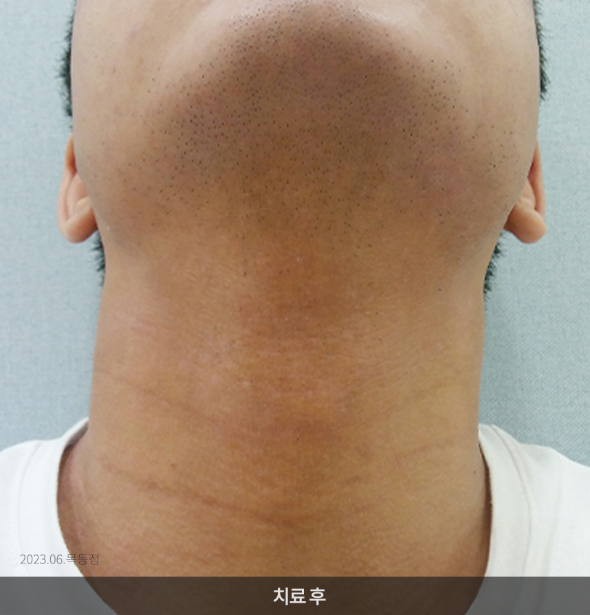 아토피 치료 후 사진