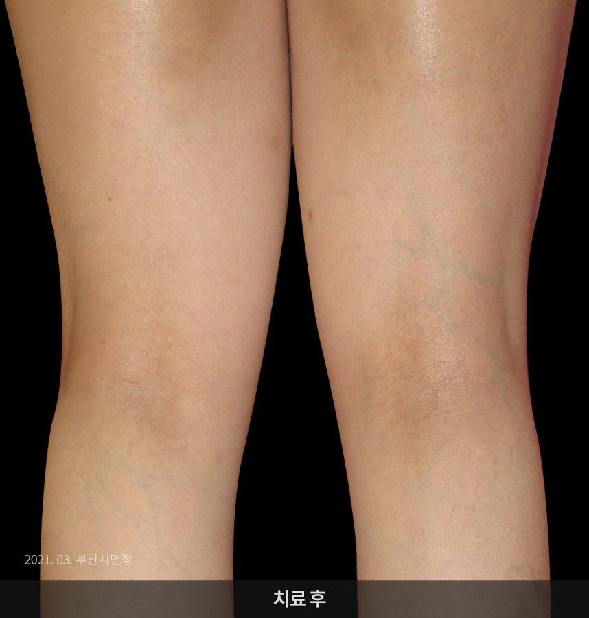 아토피 치료 후 사진