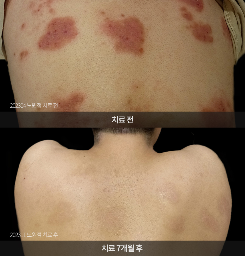 아토피 치료 전후 사례