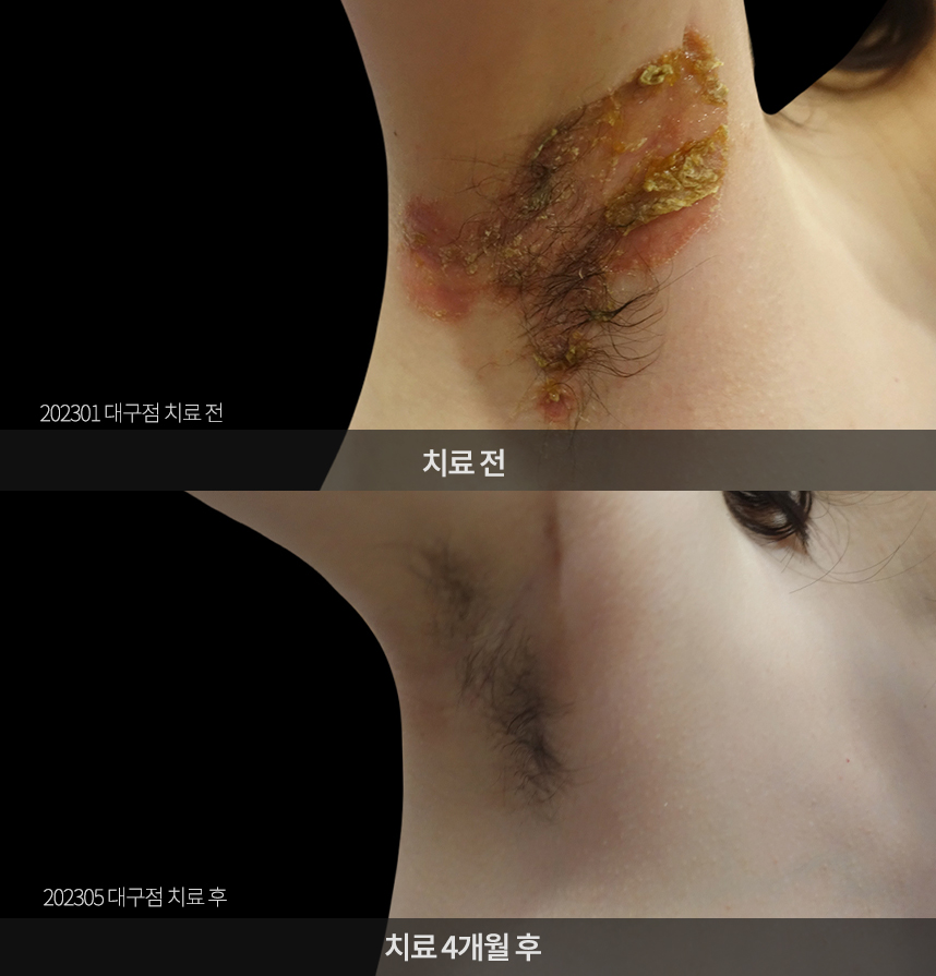 아토피 치료 전후 사례
