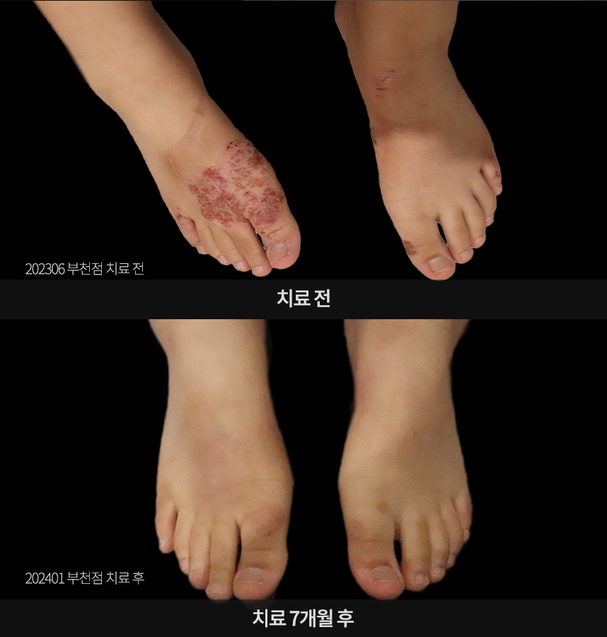 아토피 치료 전후 사례