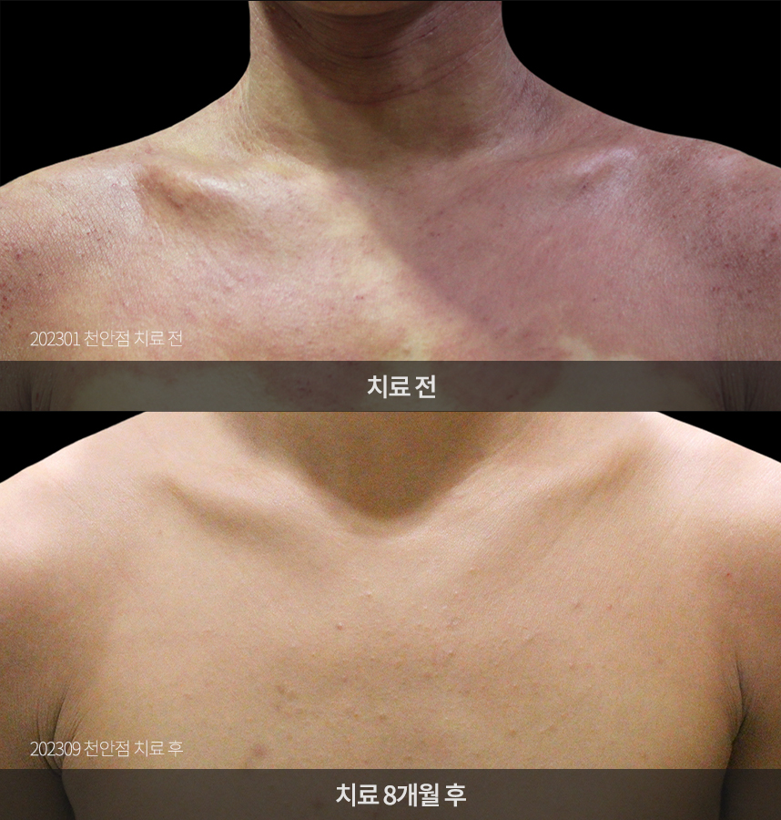 아토피 치료 전후 사례