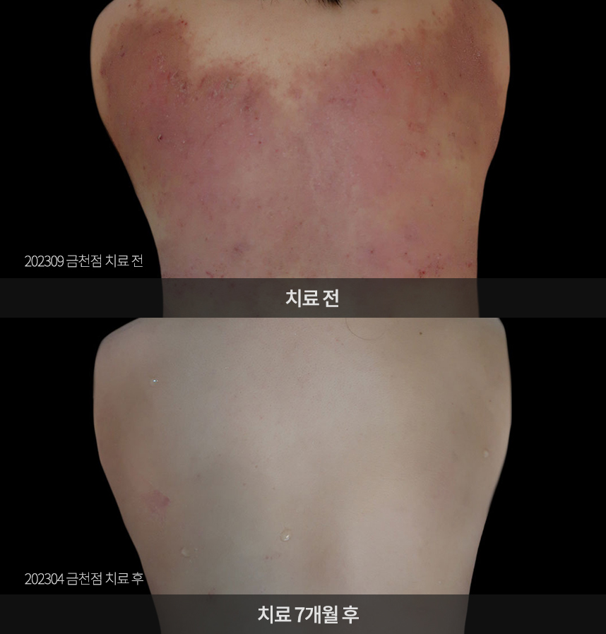 아토피 치료 전후 사례