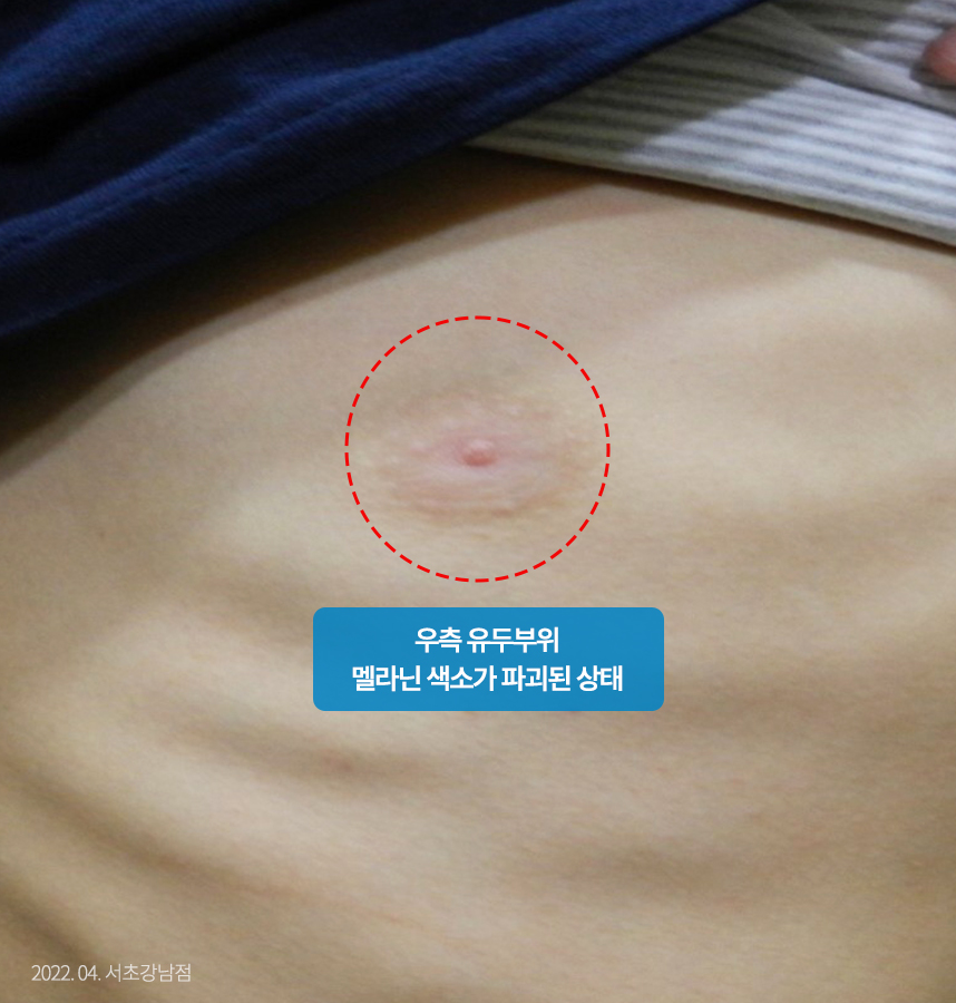 백반증 치료 전 사진