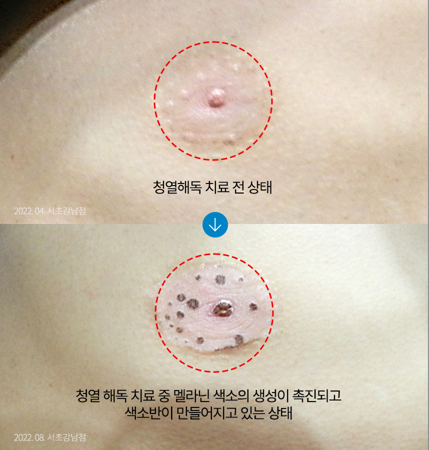 백반증 치료 전 사진