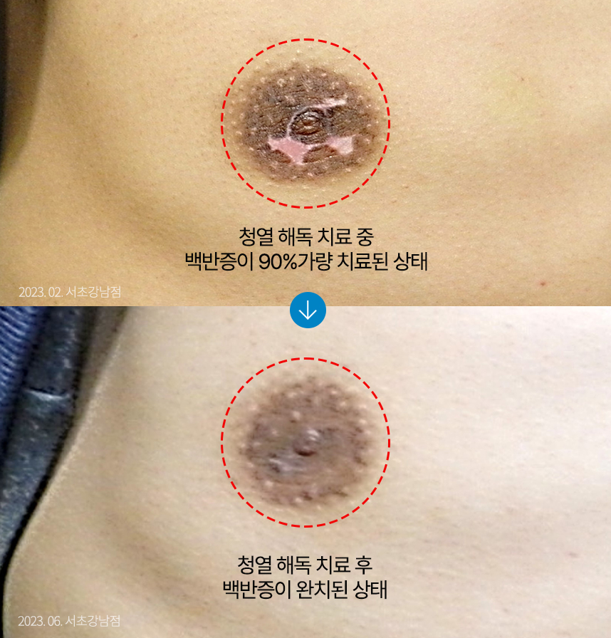 백반증 치료 전 사진