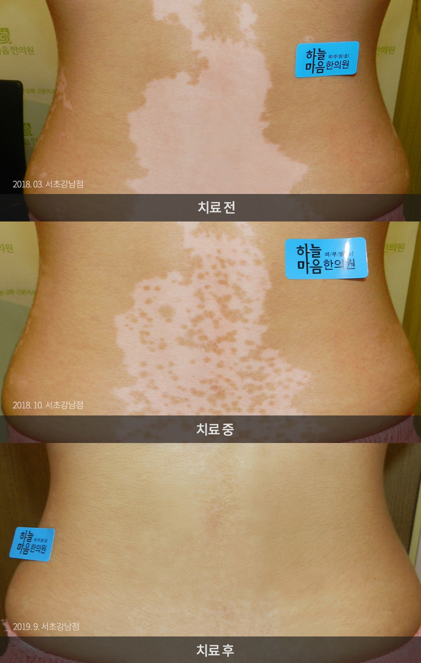 백반증 치료 전 사진