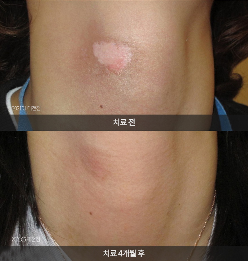 백반증 치료 전후 사례