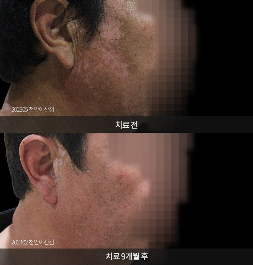 백반증 치료 전후 사례