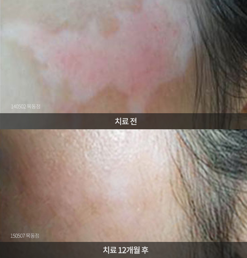 백반증 치료 전후 사례