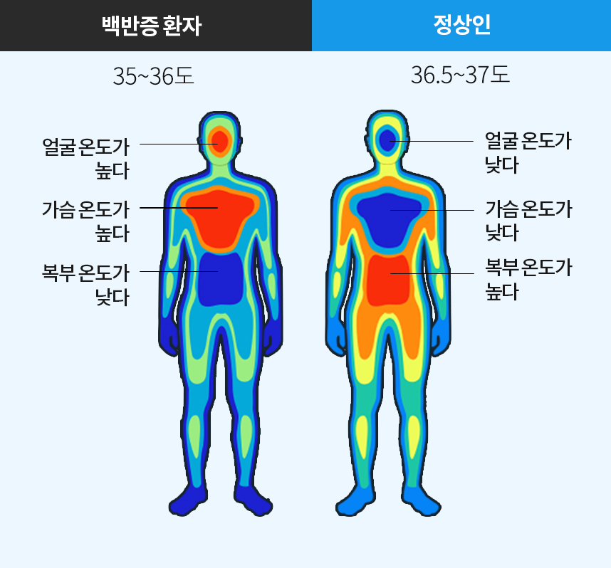 백반증환자 체온