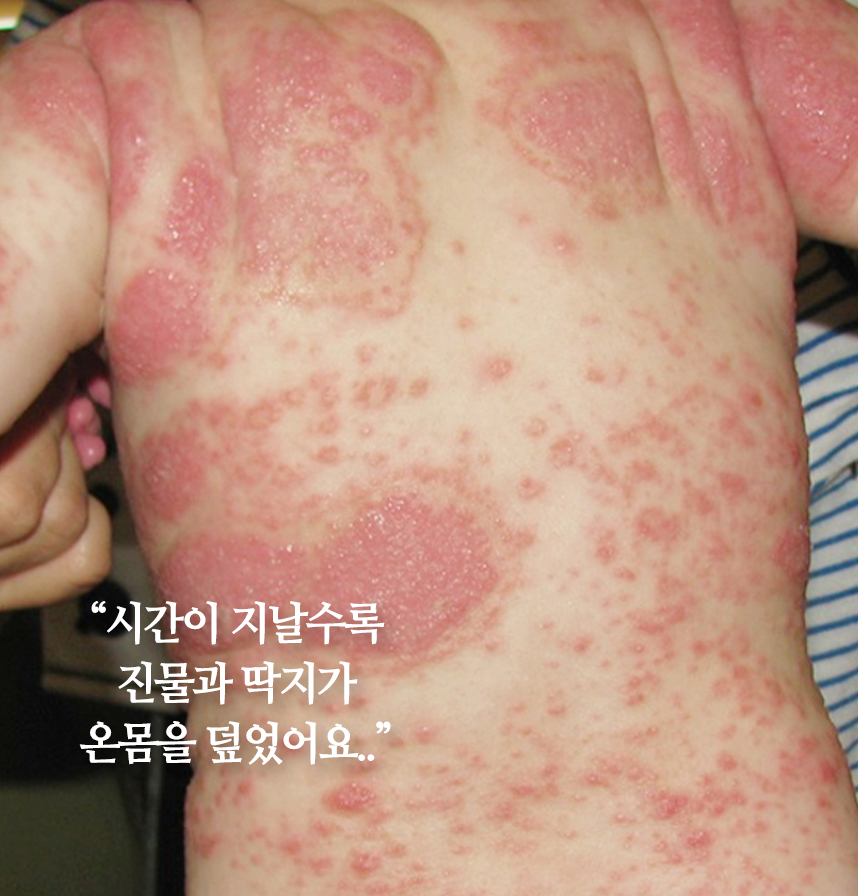 온몸이 소아 아토피으로 뒤덮힌 환자