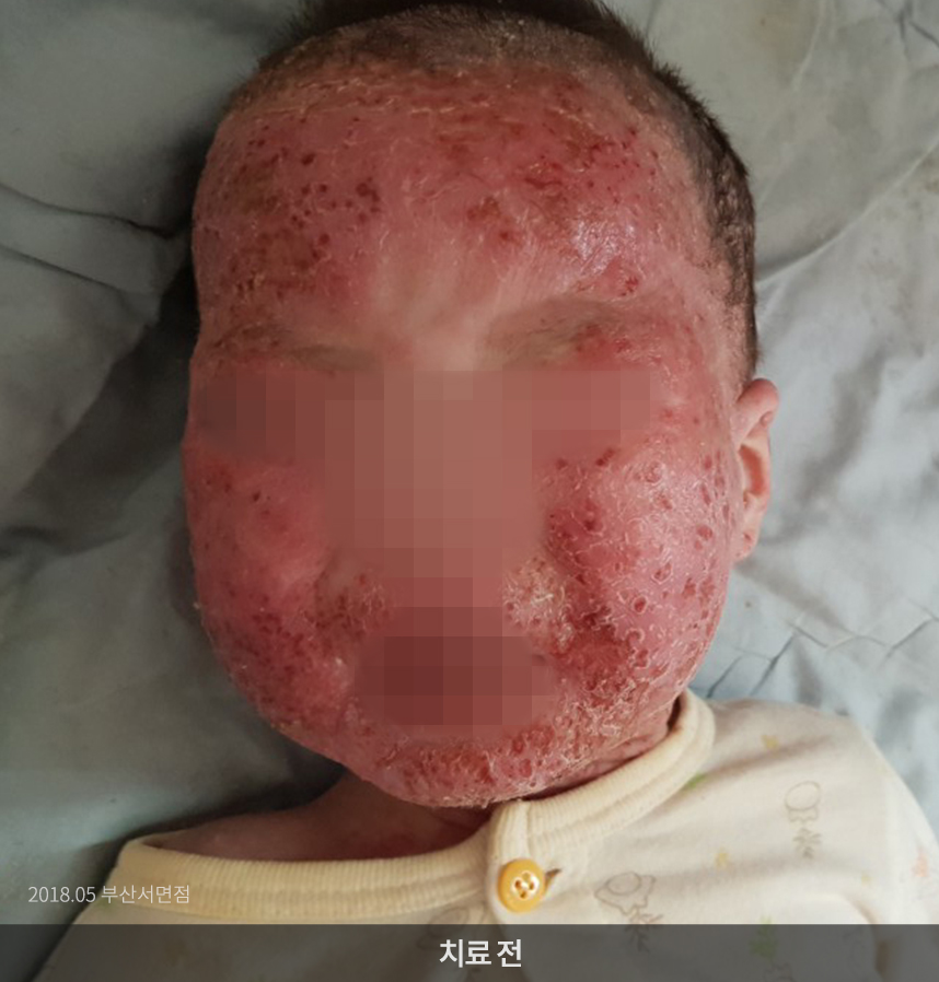 소아 아토피 치료 전 사진