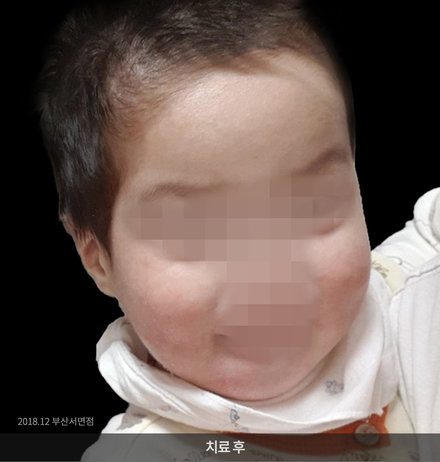 소아 아토피 치료 후 사진