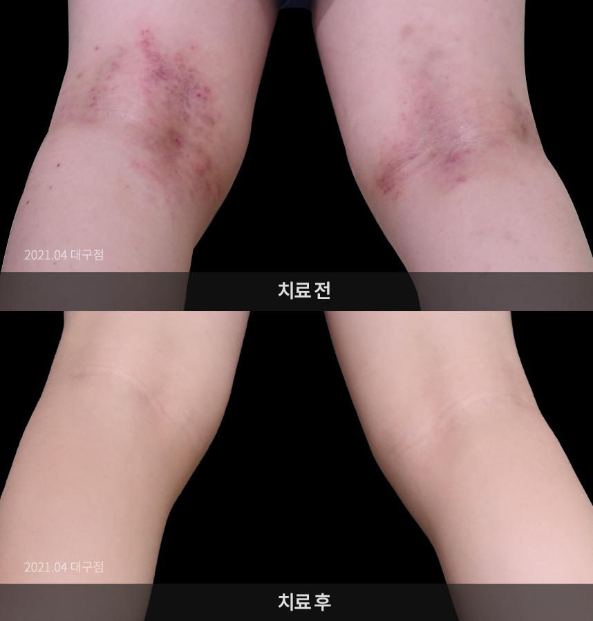 소아 아토피 치료 전 사진