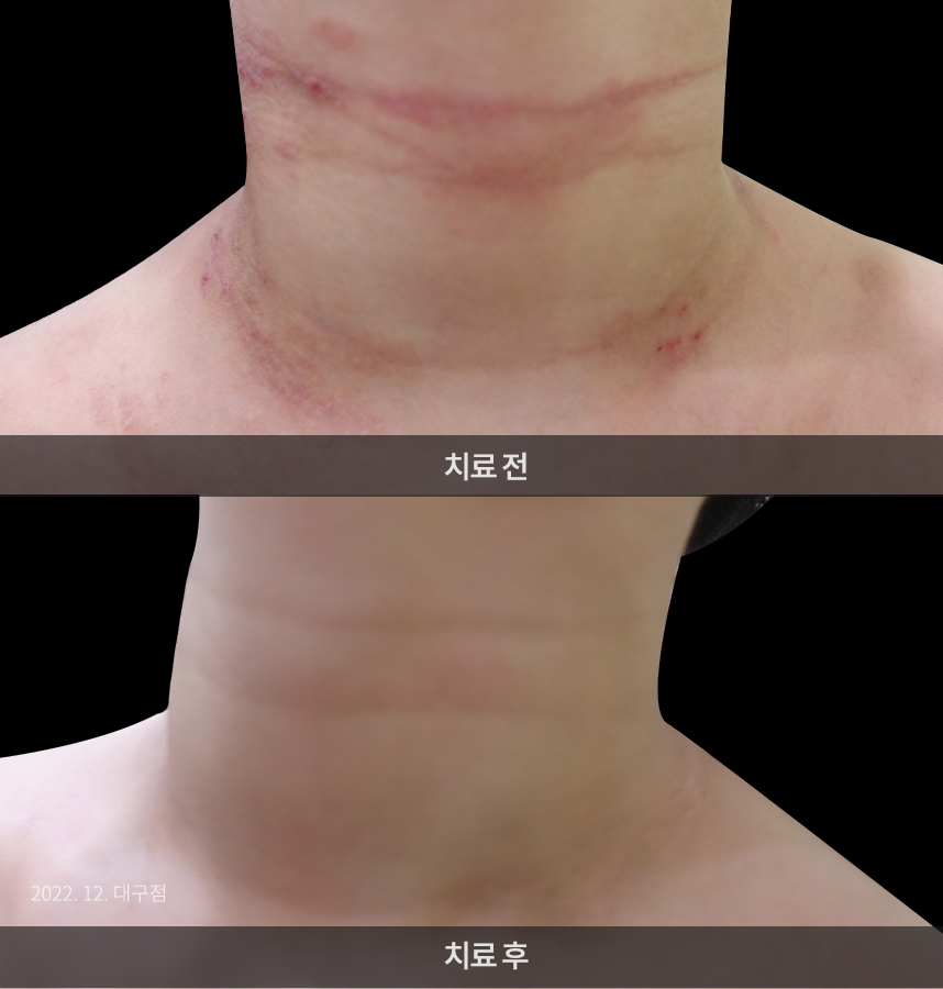 소아 아토피 치료 후 사진