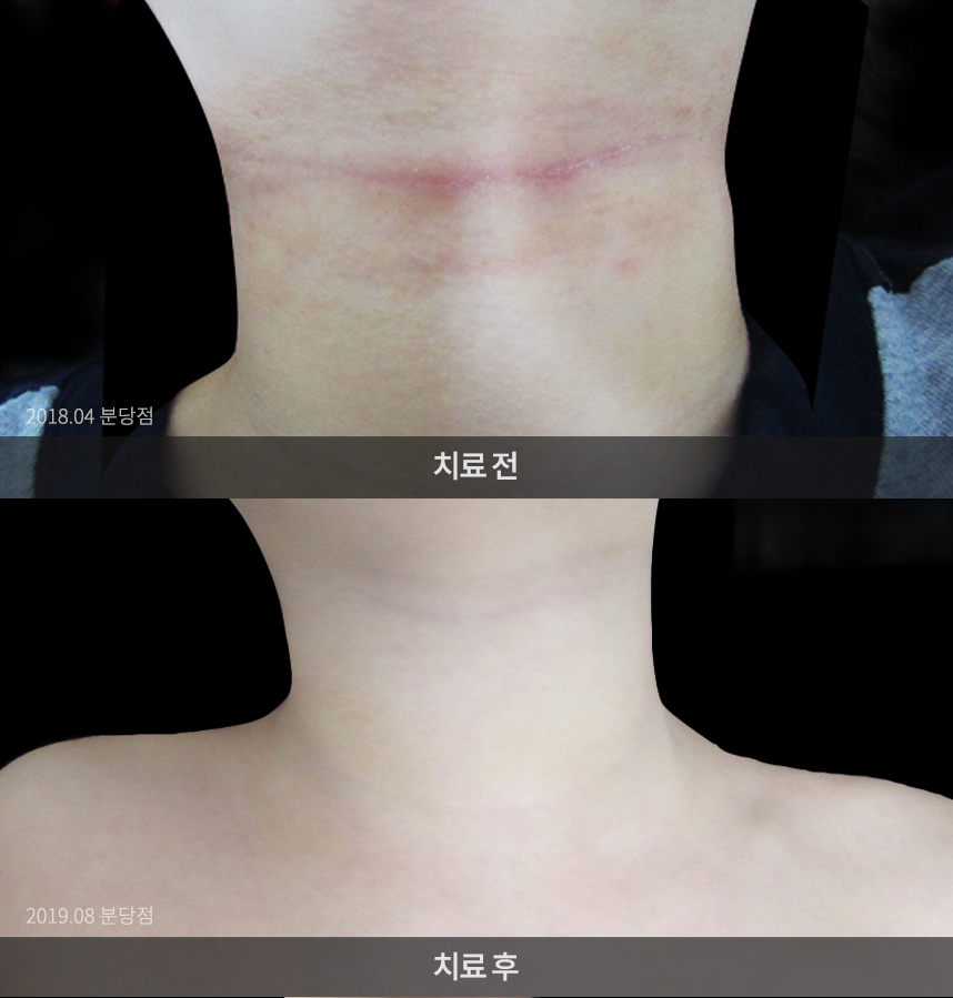 소아 아토피 치료 전 사진