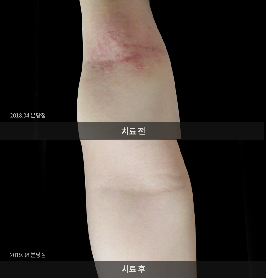 소아 아토피 치료 후 사진