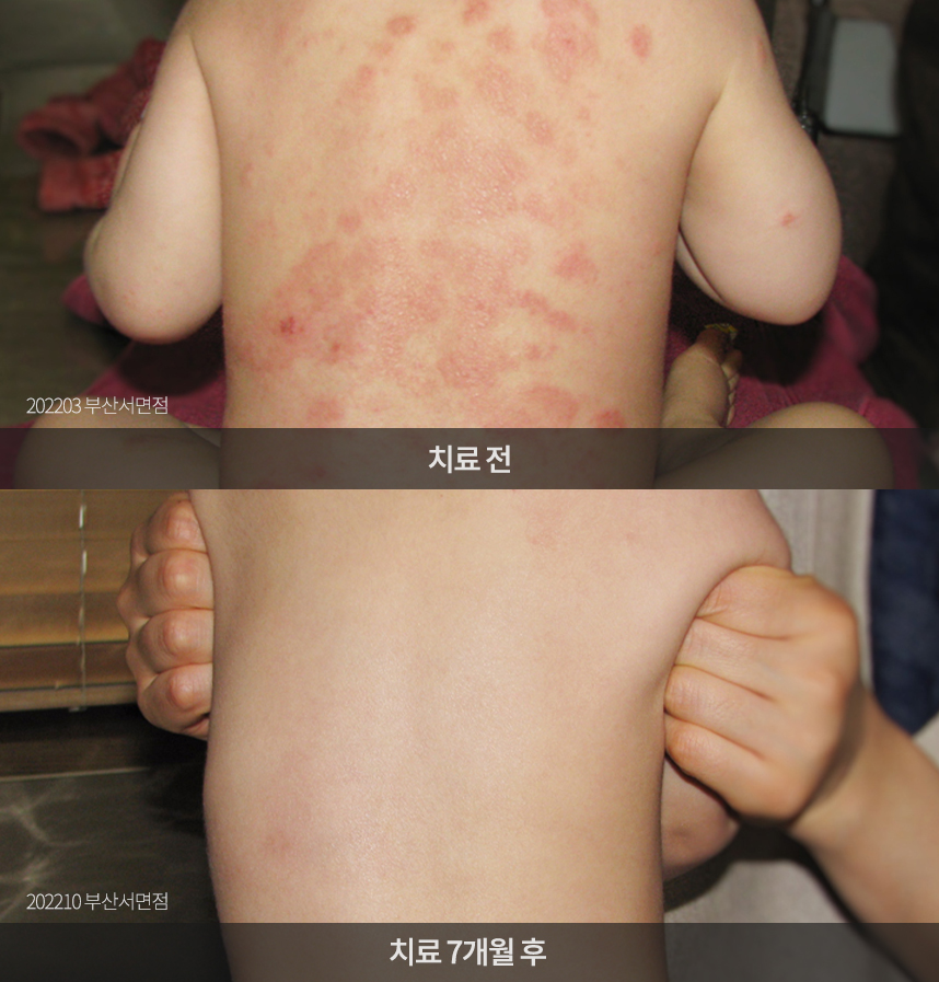 소아 아토피 치료 전후 사례