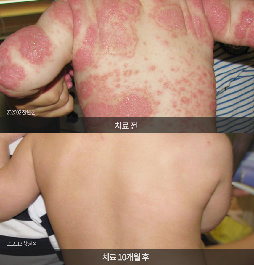 소아 아토피 치료 전후 사례