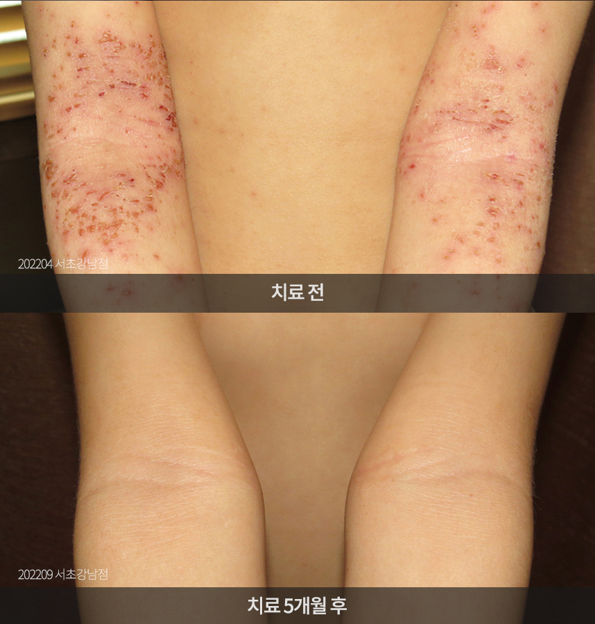 소아 아토피 치료 전후 사례